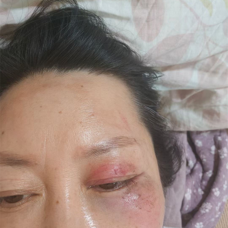 红血丝＋蚊虫叮咬案例